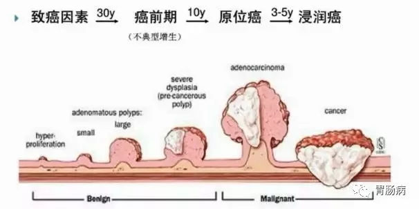 體檢查出腸息肉一定要切除！ 95%腸癌由它演變而來(lái)